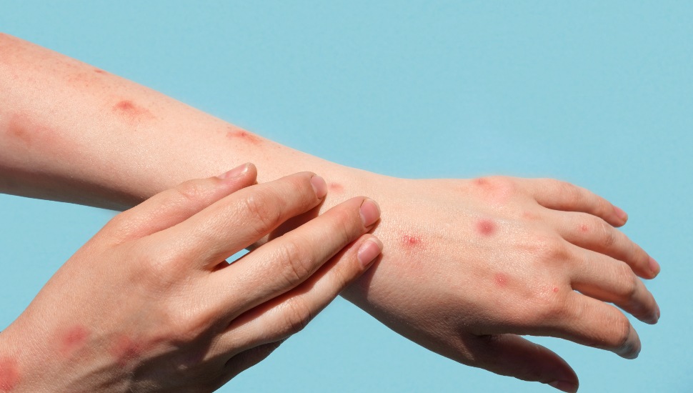 An arm and hand with a rash from the monkeypox virus.